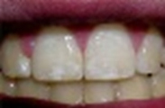 軽度の斑状歯