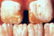 重度の斑状歯